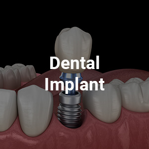 Dental Implant