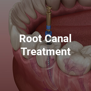 Root Canal Treatment